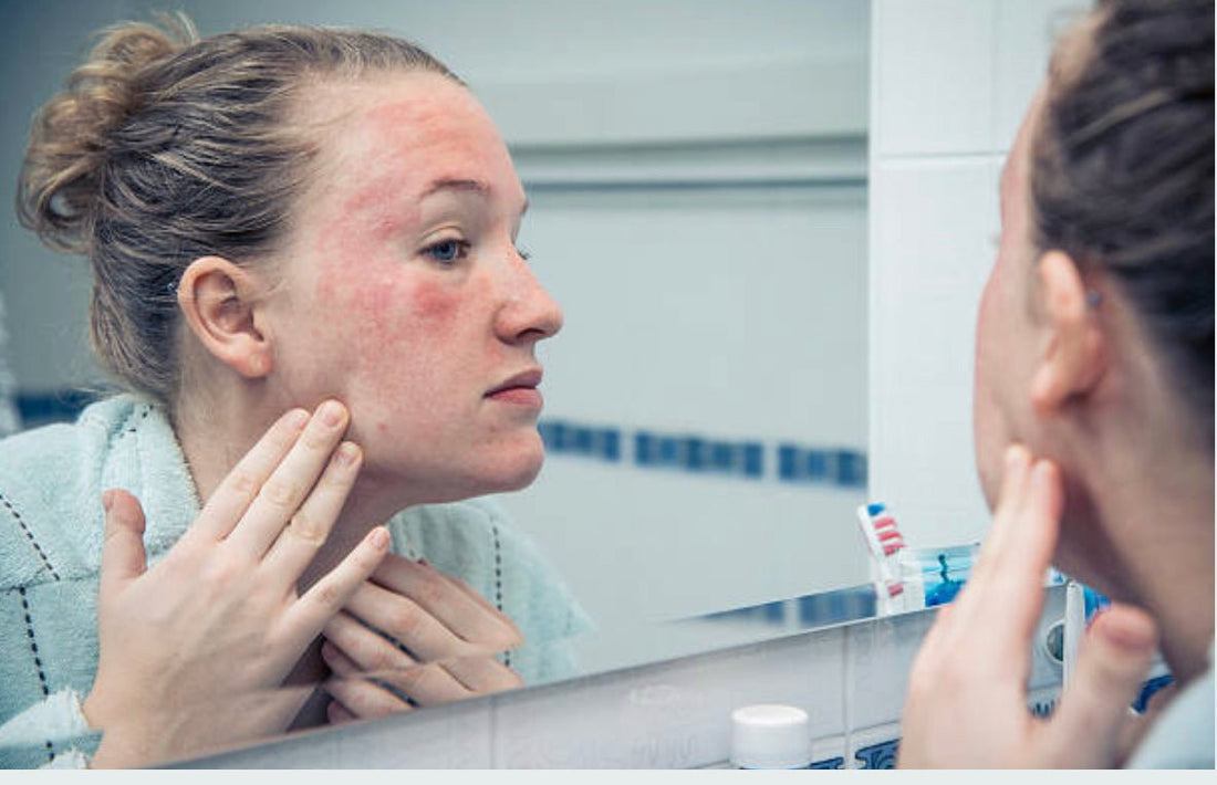 3 Ways To Prevent Rosacea Flares - Starest